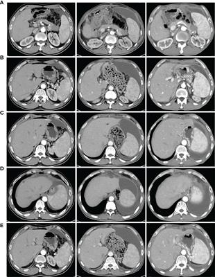 Vemurafenib Combined With Trametinib Significantly Benefits the Survival of a Patient With Stage IV Pancreatic Ductal Adenocarcinoma With BRAF V600E Mutation: A Case Report